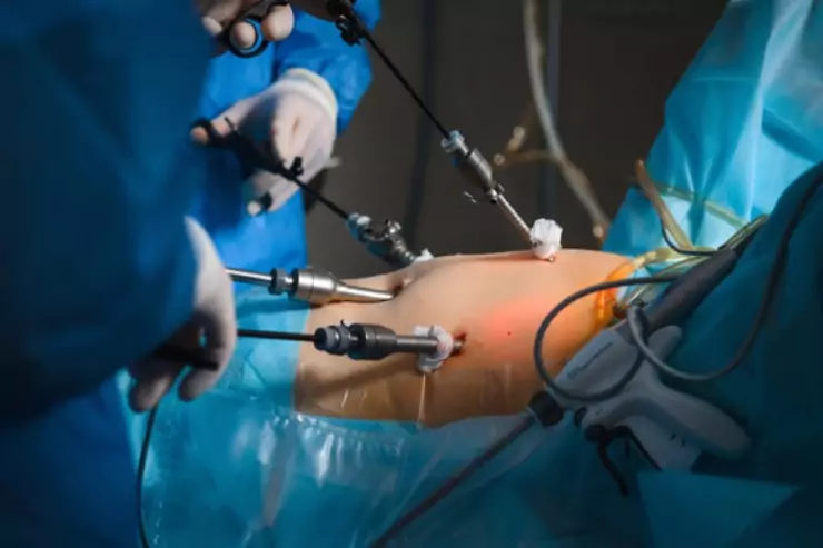 hernia-surgery-with-laparoscopic-hernia-25-685e29a82199f