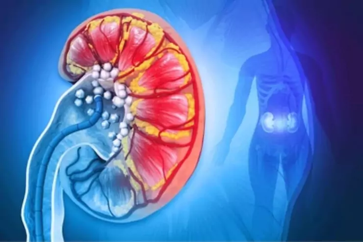 Kidney Stone Management