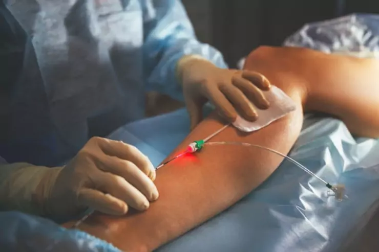 varicose-veins-surgery